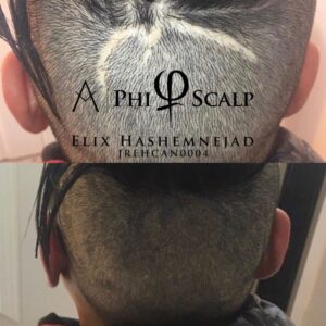 Scalp Micropigmentation 01 - Scalp Micropigmentation Gallery
