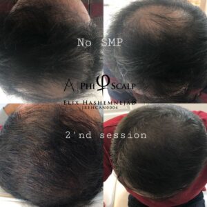 Scalp Micropigmentation 02 - Scalp Micropigmentation Gallery