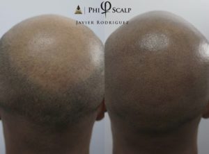 Scalp Micropigmentation 04 - Scalp Micropigmentation Gallery