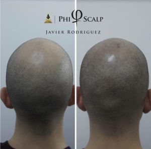 Scalp Micropigmentation 05 - Scalp Micropigmentation Gallery