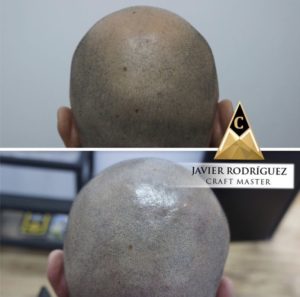 Scalp Micropigmentation 06 - Scalp Micropigmentation Gallery