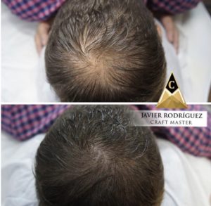 Scalp Micropigmentation 07 - Scalp Micropigmentation Gallery