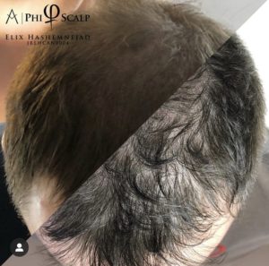 Scalp Micropigmentation 08 - Scalp Micropigmentation Gallery