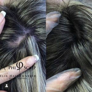 Scalp Micropigmentation 09 - Scalp Micropigmentation Gallery