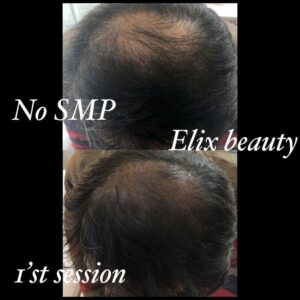 Scalp Micropigmentation 10 - Scalp Micropigmentation Gallery