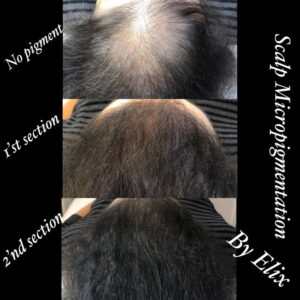 Scalp Micropigmentation 11 - Scalp Micropigmentation Gallery