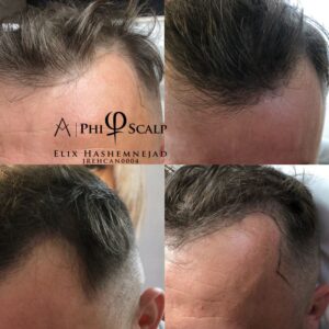 Scalp Micropigmentation 12 - Scalp Micropigmentation Gallery