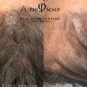 Scalp Micropigmentation 15 - Scalp Micropigmentation Gallery