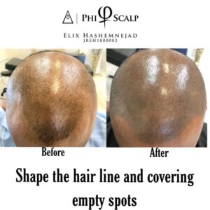 Scalp Micropigmentation 16 - Scalp Micropigmentation Gallery