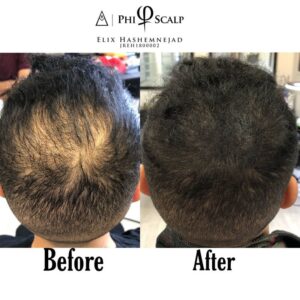 Scalp Micropigmentation 17 - Scalp Micropigmentation Gallery