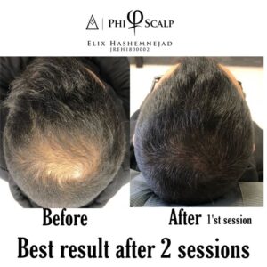 Scalp Micropigmentation 18 - Scalp Micropigmentation Gallery
