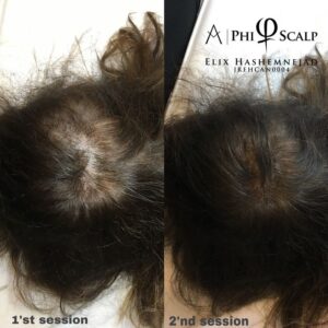 Scalp Micropigmentation 19 - Scalp Micropigmentation Gallery