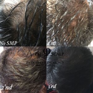 Scalp Micropigmentation 20 - Scalp Micropigmentation Gallery