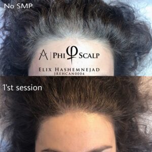Scalp Micropigmentation 21 - Scalp Micropigmentation Gallery