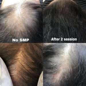 Scalp Micropigmentation 22 - Scalp Micropigmentation Gallery