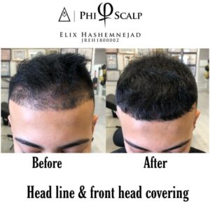 Scalp Micropigmentation 24 - Scalp Micropigmentation Gallery