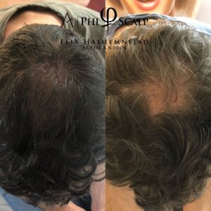 Scalp Micropigmentation 25 - Scalp Micropigmentation Gallery