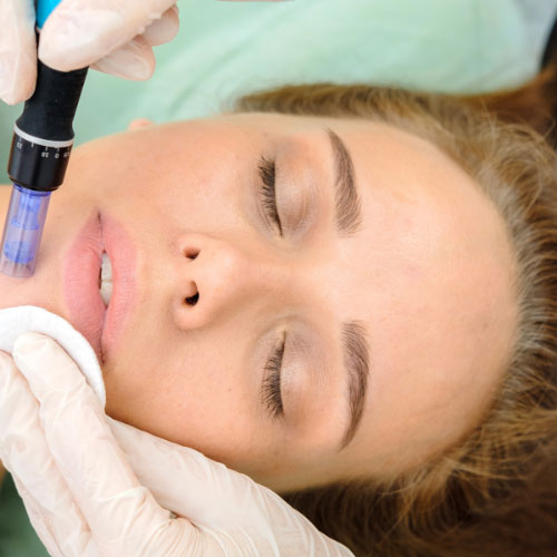 How painful is the Microneedling process?