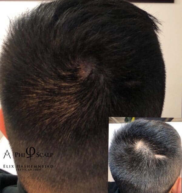 popular reasons to use scalp micropigmentation