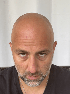 Scalp Micropigmentation - Elix Beauty - Eyebrow Microblading & Scalp Micropigmentation, Services and Training by Phi Academy Master b 1 - Scalp Micropigmentation