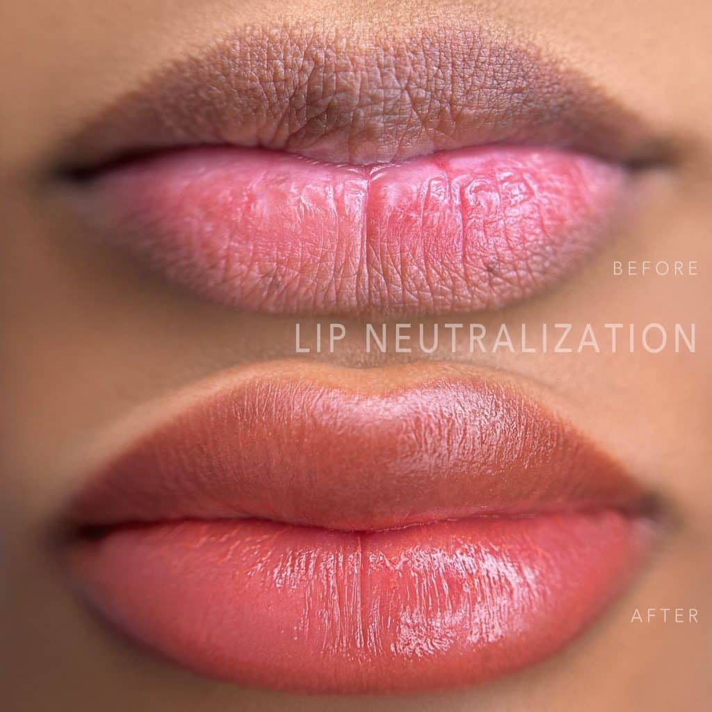 IMG 6272 - Dark Lip Neutralization