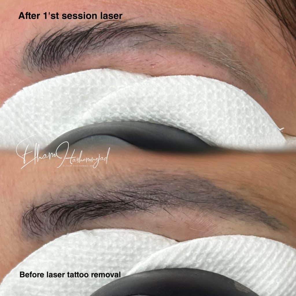 IMG 9695 - Brow Correction Experts in Newmarket Elix Beauty