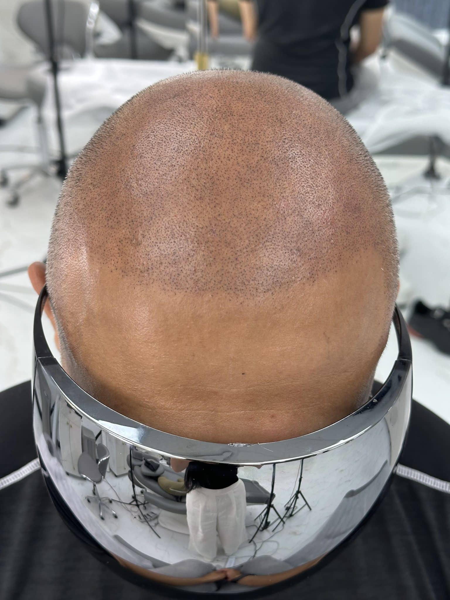 67D1A195 78F2 41D5 9781 39C56CF4E4D6 scaled - SMP Newmarket : The Modern Solution to Hair Loss