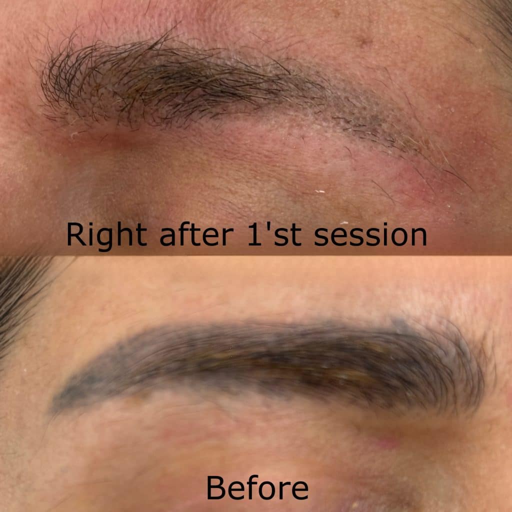 0B3B8ADF 78FA 4231 B743 70E197C9BBE7 - Remove Old Brow Tattoos | Newmarket Tattoo Removal